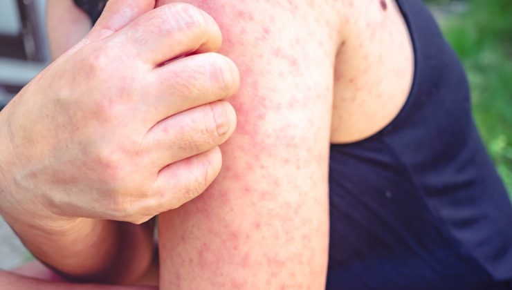 Kızamık belirtileri neler, nasıl geçer?